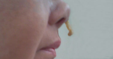 Doctor Cao treating a patient with Acupuncture at the East West College of Natural Medicine.