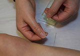Doctor Cao applying Acupuncture needles at the East West College of Natural Medicine.