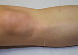 Doctor Cao treating a patients knee with Acupuncture at the East West College of Natural Medicine.