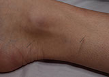 Doctor Cao treating a patients ankle with Acupuncture at the East West College of Natural Medicine.